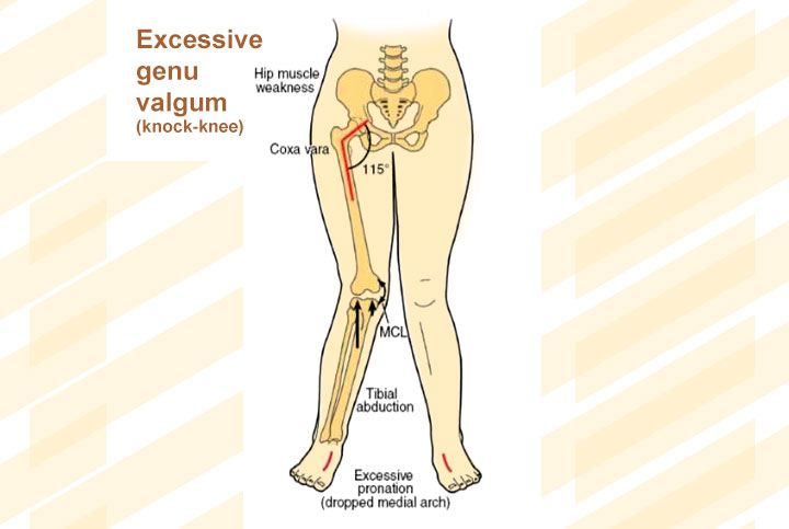 Flat feet can cause knee pain